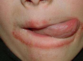 Шелушение кожи вокруг рта при частом облизывании губ