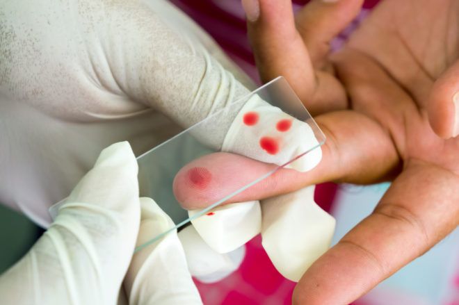 При паппиломе проводится общий анализ крови для выявления сопуствующих заболеваний