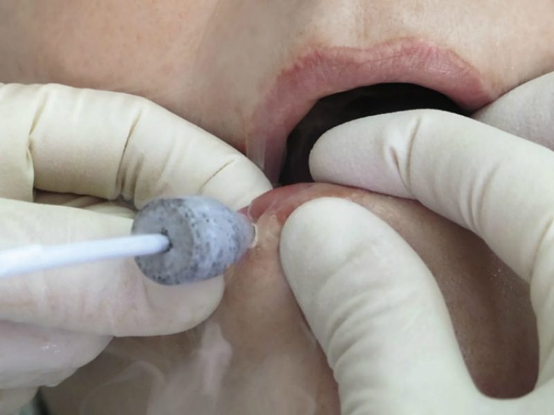 Удаление бородавки азотом на губе