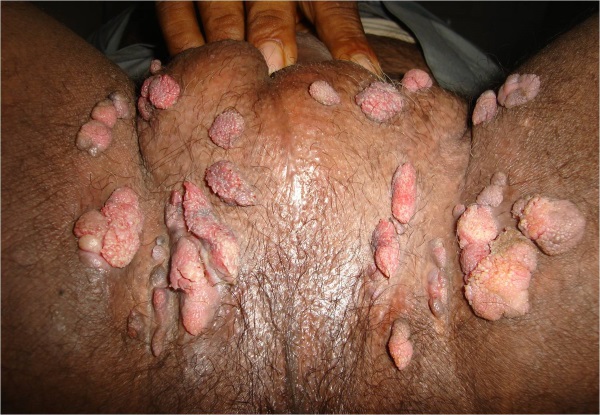 Папилломы у мужчин - вирус человека, фото, на интимном месте, лечение, на головке