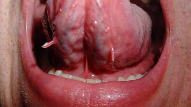 Папилломы полости рта - причины, симптомы, диагностика и лечение