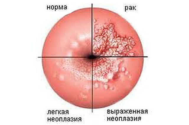 Вирус папилломы человека 16 и 18 типа у женщин: лечение, препараты