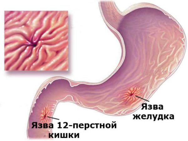 Желчь в желудке  дуоденогастральный рефлюкс