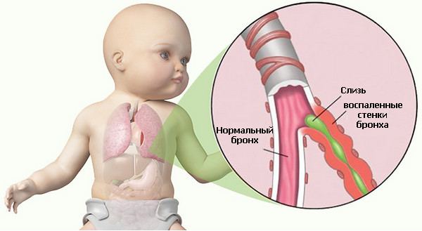 Иллюстрация воспаленного бронха у ребенка