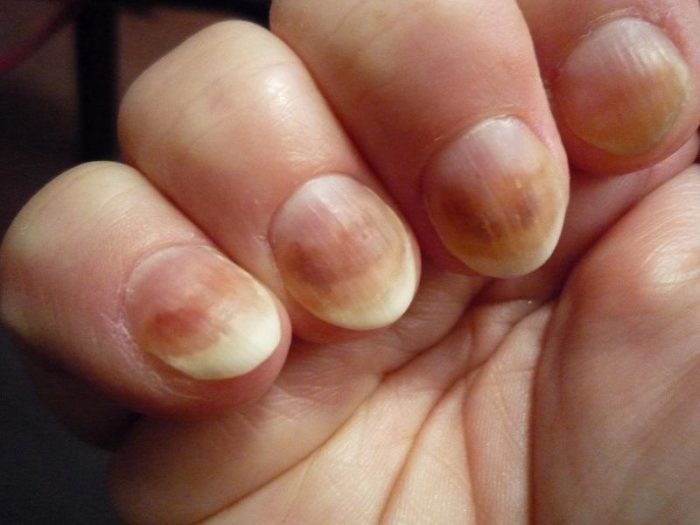 Изменение цвета ногтевой пластины является одним из симптомов заболевания