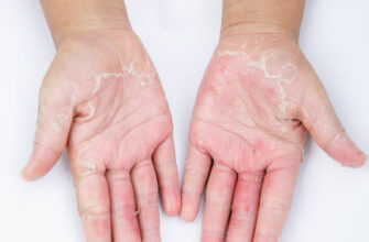 atopicheskij dermatit na rukah 1