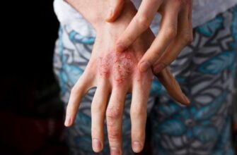 dermatit mezhdu palcami ruk i nog 1
