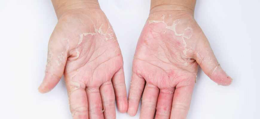 dermatit na rukah