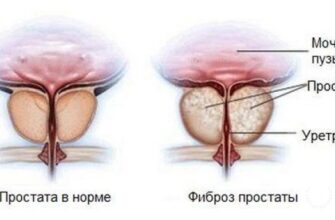 fibroz prostaty chto eto za bolezn