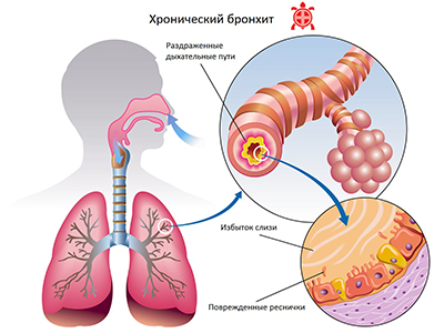 hronicheskij bronhit
