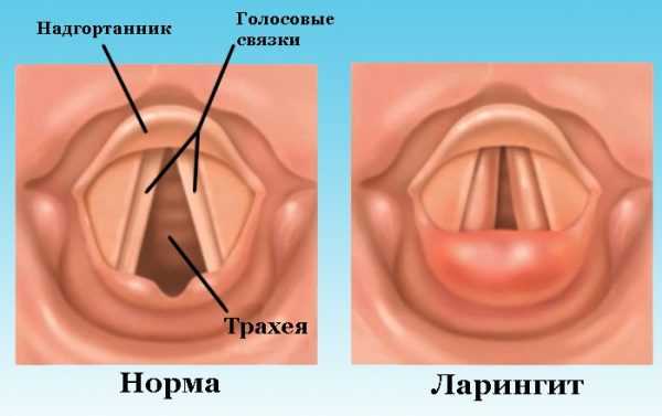 hronicheskij laringit prichiny vidy simptomy lechenie