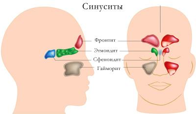 hronicheskij sinusit