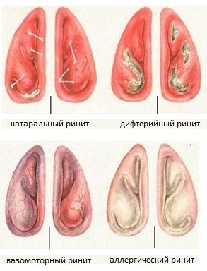 hronicheskij vazomotornyj rinit