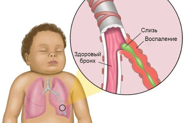 kak lechit obstruktivnyj bronhit u detej