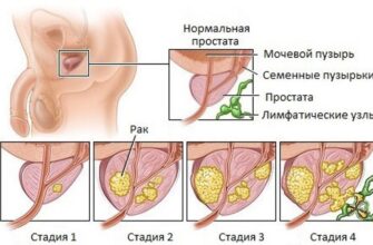 kakoj prognoz pri adenome prostaty na raznyh stadiyah zabolevaniya