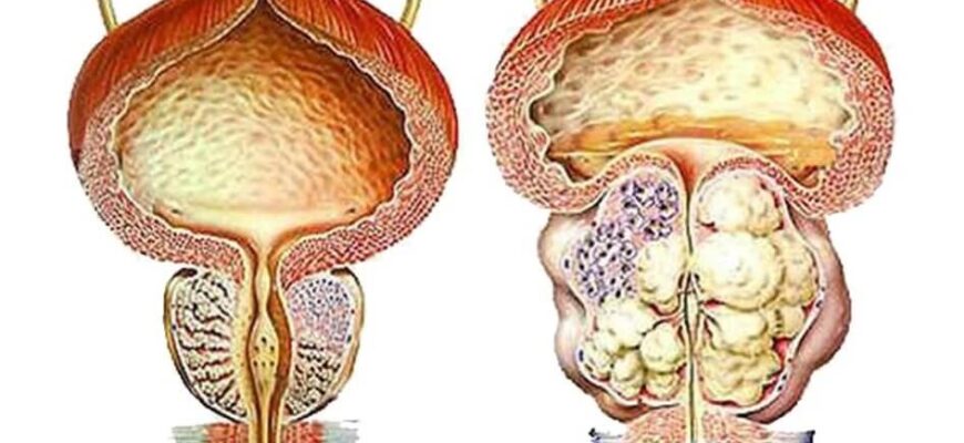 kakuju rol igraet norma ostatochnoj mochi pri adenome prostaty