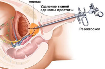 lechenie prostatita i adenomy prostaty s pomoshhju igloukalyvaniya