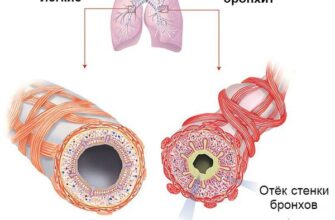 obstruktivnyj bronhit