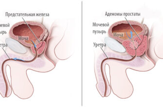 osnovnye priznaki prostatita i adenomy prostaty na uzi