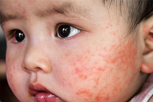 seborejnyj dermatit u detej kak bystro raspoznat i effektivno vylechit