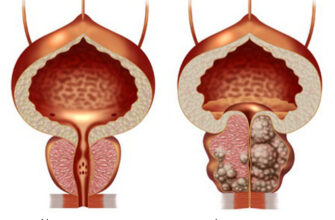 simptomy i lechenie adenomy prostaty u muzhchin