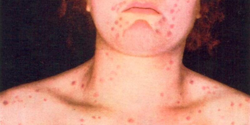 simptomy sifilisa u muzhchin v raznye periody bolezni