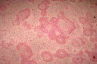 toksiko allergicheskij dermatit 1