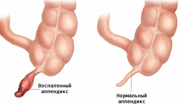 appendicit prichiny simptomy i lechenie 1