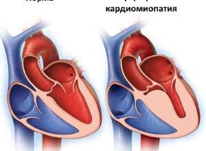 gipertroficheskaya kardiomiopatiya 1