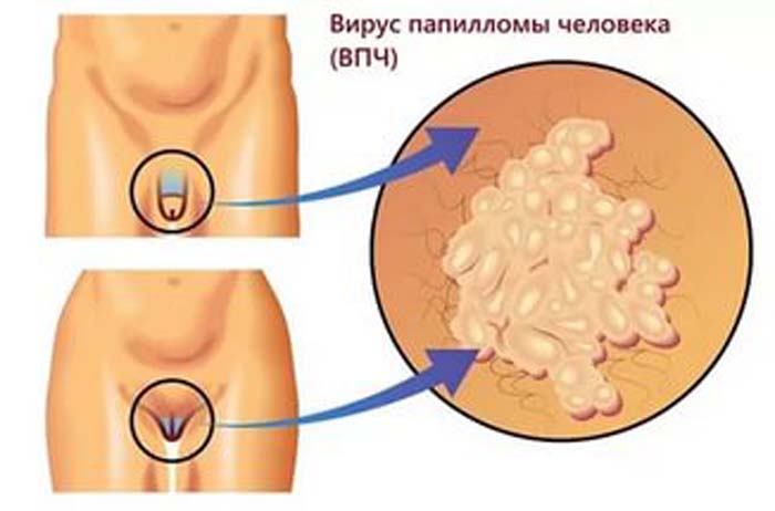 Вирус папилломы человека на теле, ВПЧ что это такое