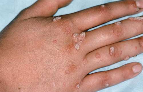papillomavirus cheloveka u muzhchin vpch simptomy i lechenie